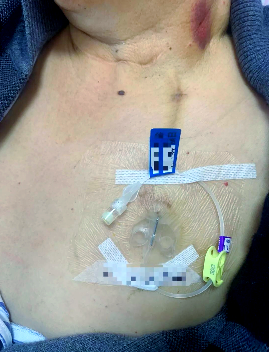 输液港:一种特殊的输液方式,让爱美的肿瘤患者重焕光彩