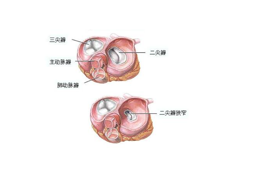 肺动脉瓣狭窄图片图片