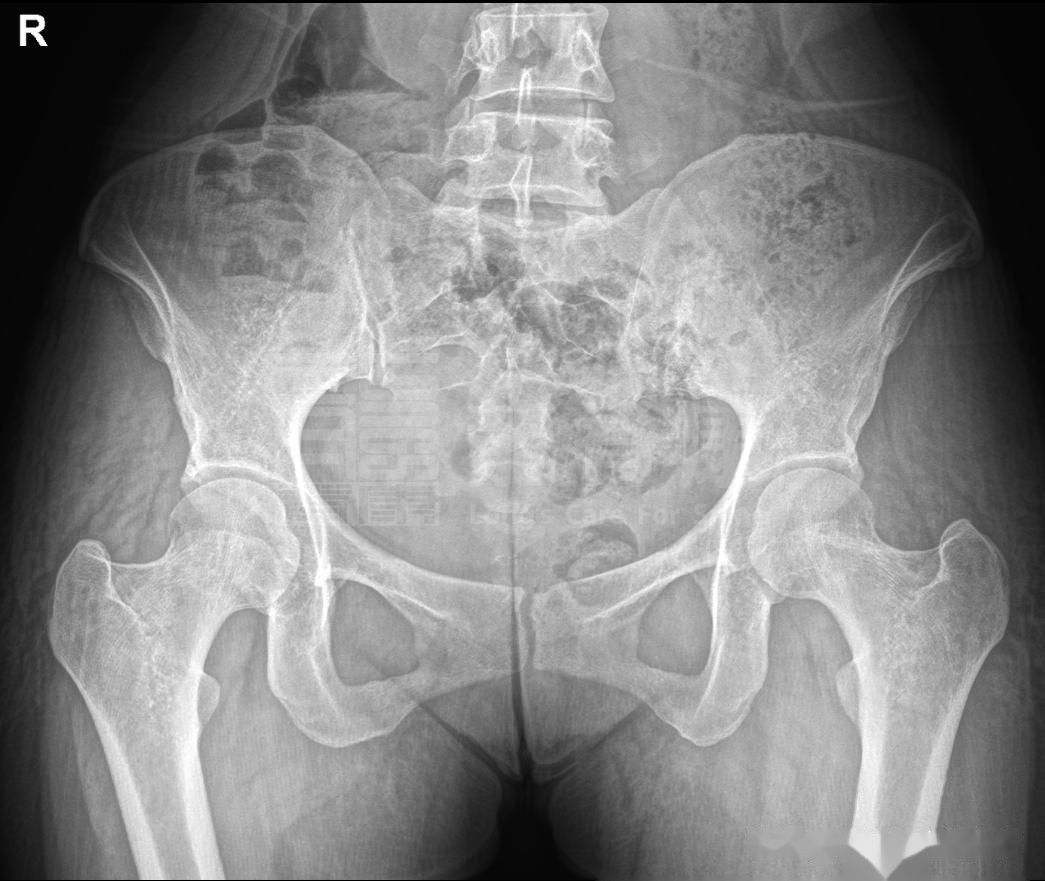 腰骶部伴下肢牵扯痛,骶髂关节错位,该如何康复治疗?