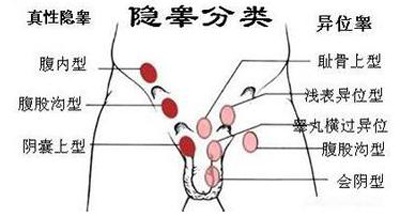 孩子只有一个蛋蛋 医生 极少见的睾丸横过异位