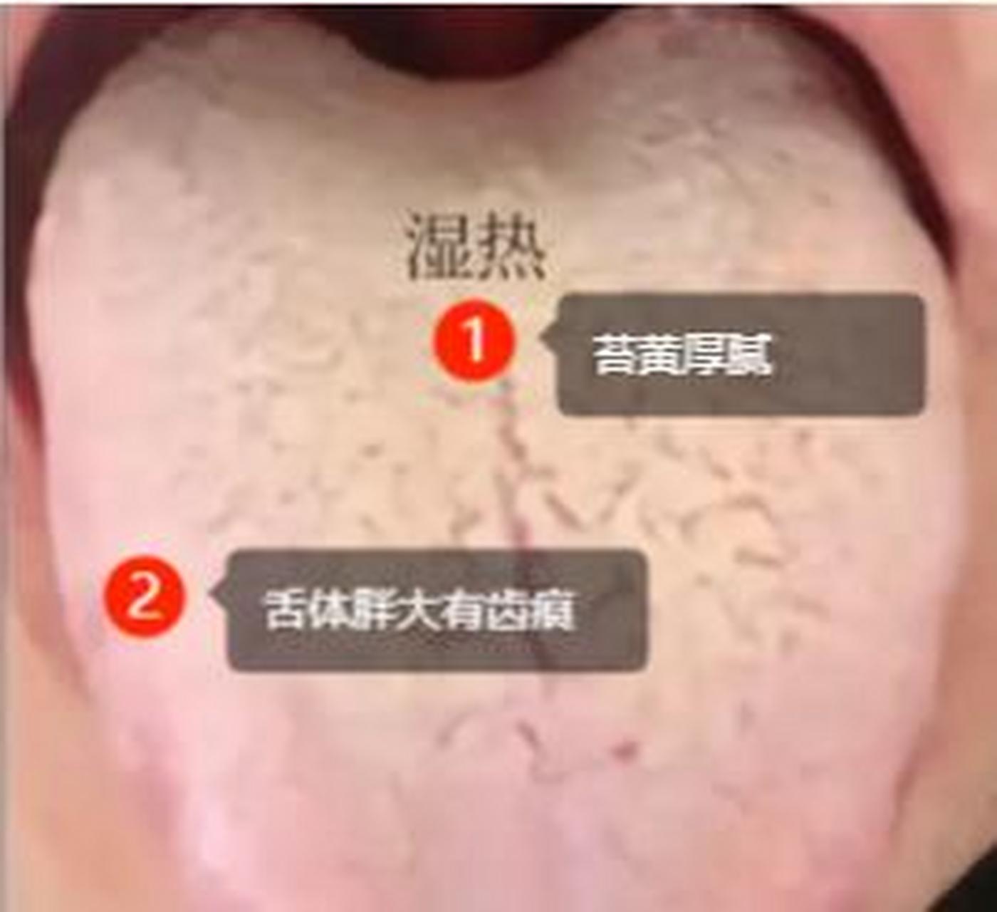 【常见的三种舌苔,痰湿,寒湿,湿热,对比一下你自己】 痰湿湿舌象:舌体