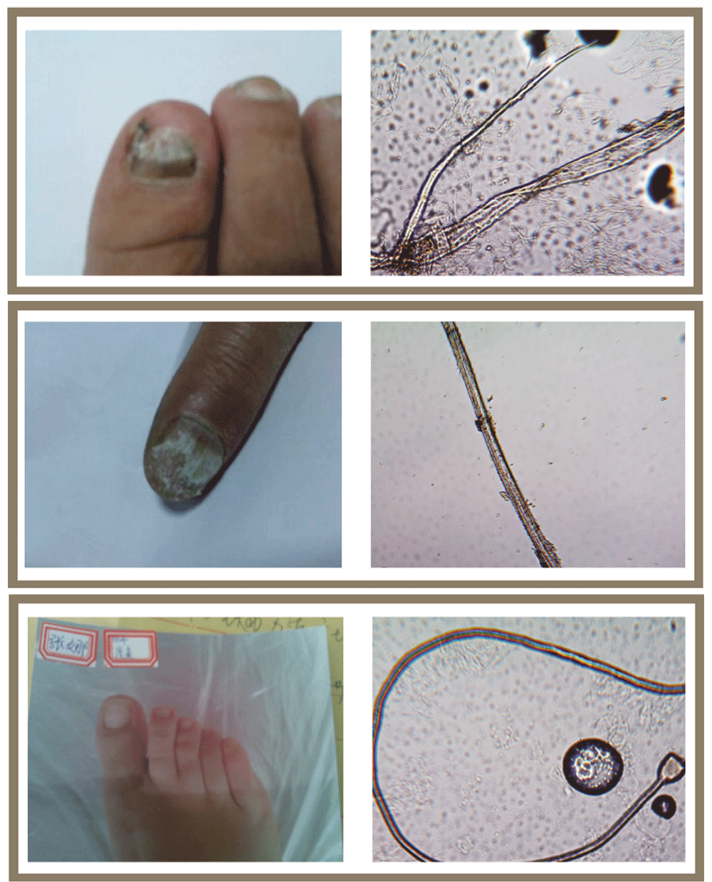 灰指甲显微镜下 真菌图片
