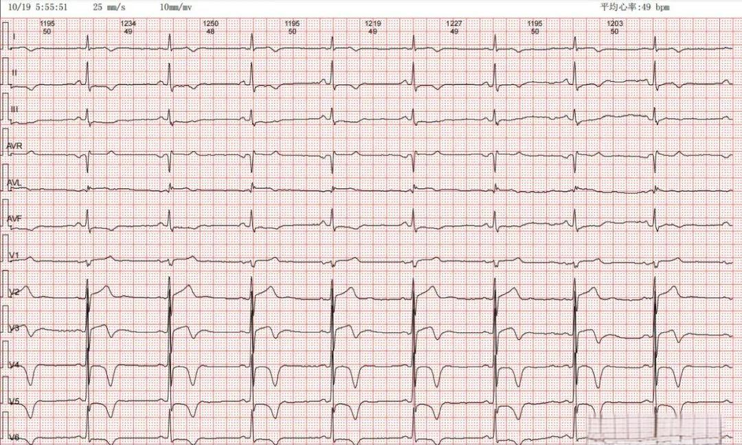 心肌桥的心电图特征及诊断方法详解