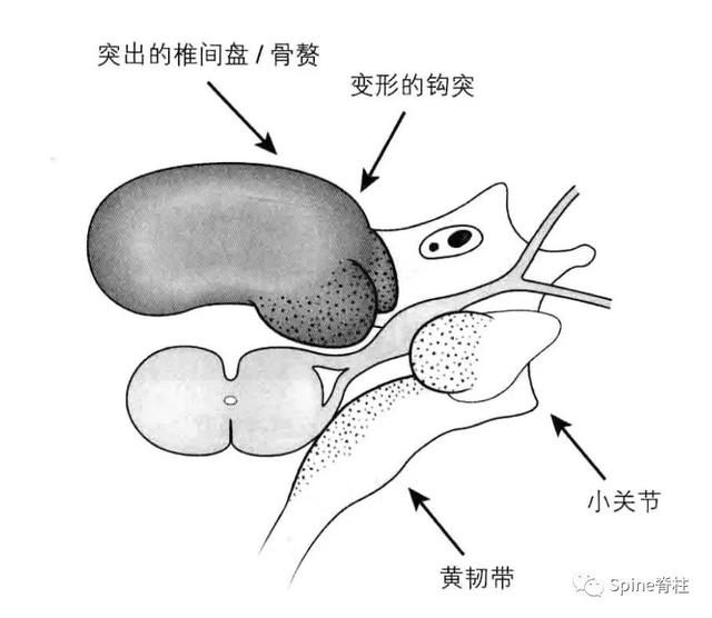 回顾:颈椎病 cervical spondylosis