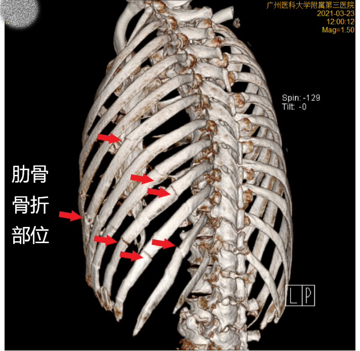 险!104岁老人摔断7根肋骨,医生成功为他"接骨"