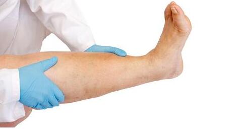 一只脚踝水肿疼痛是痛风吗?