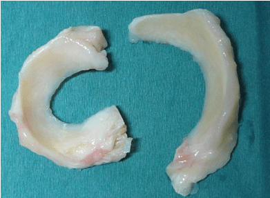 小伙特种兵式旅游致半月板损伤