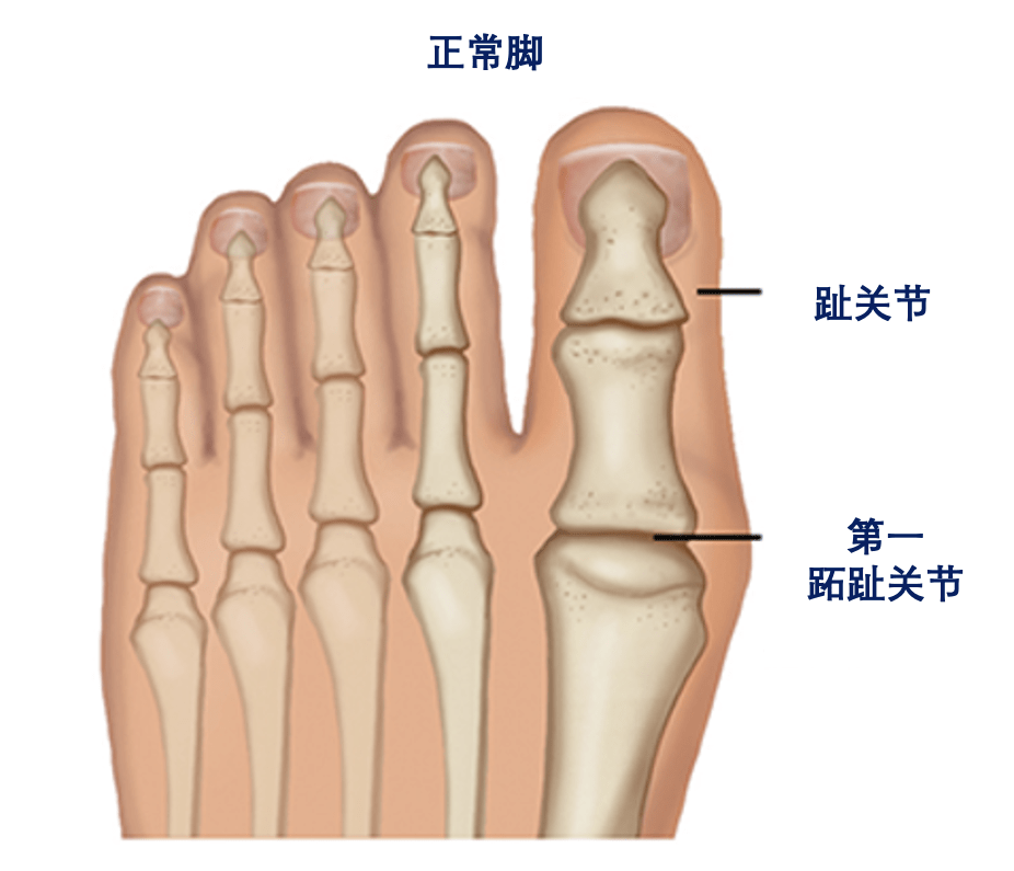 第二跖趾关节图片