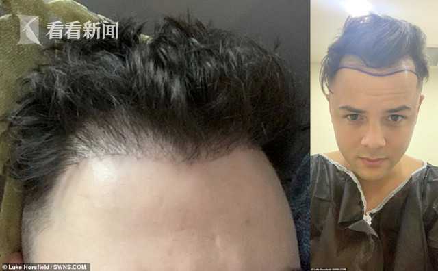 it男"超低价"出国植发 头皮布满"虫卵"丑陋恶心