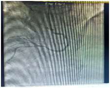 房山区第一医院成功救治一例罕见"镜像右位心合并不稳定性心绞痛"患者