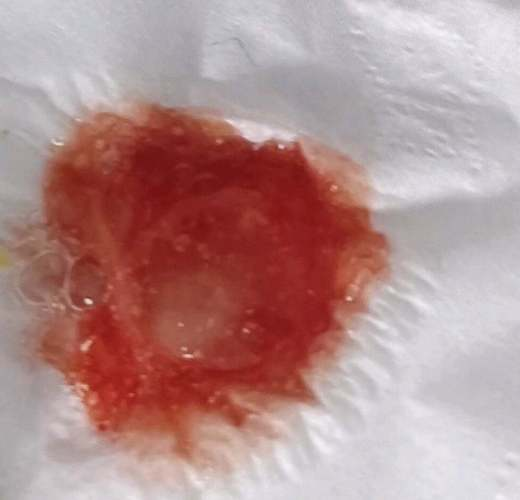 女童重症肺炎合并大咯血的临床诊治与反思