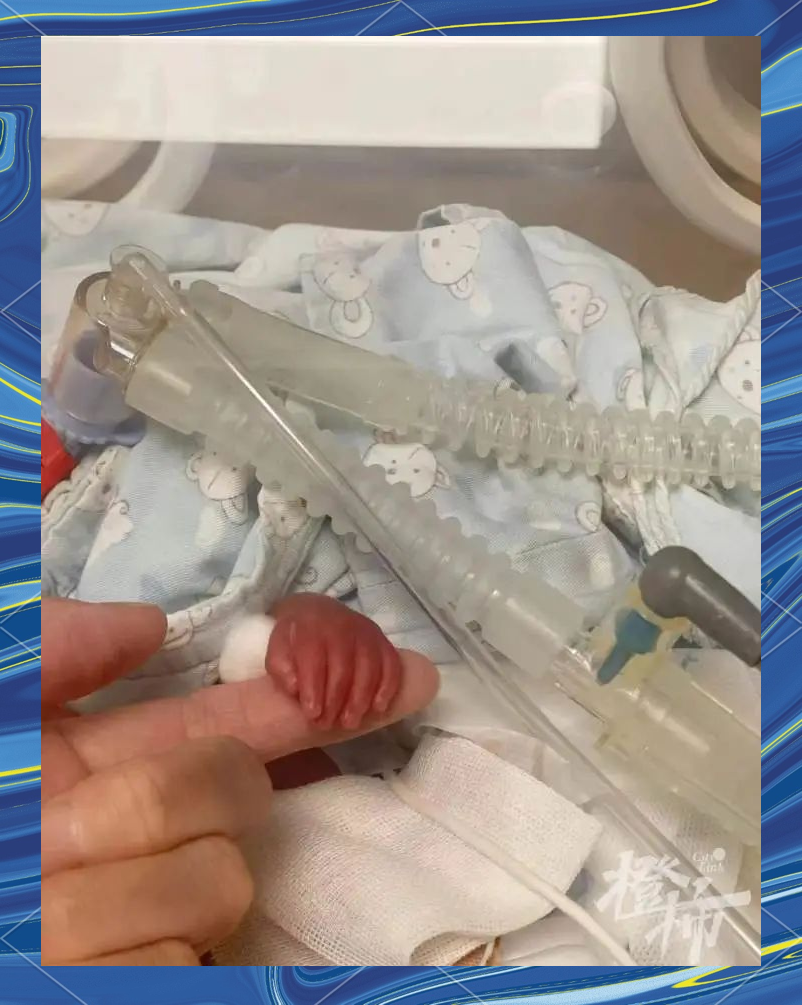 宁波超早产儿"牛油果":从手掌大小到健康成长