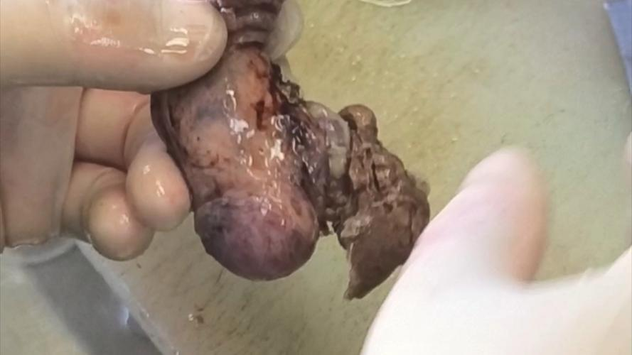 男性睾丸肿大的原因与应对策略详解