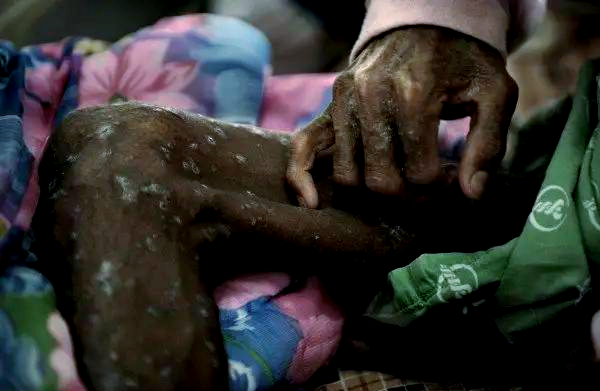 艾滋病晚期病人照片,令人震惊!