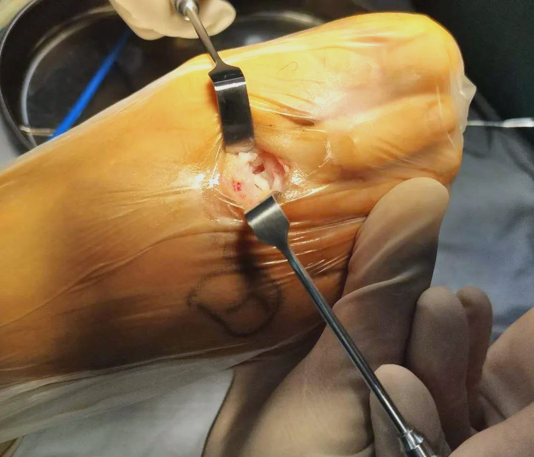 从老茧到关节:足胼胝体的防治指南