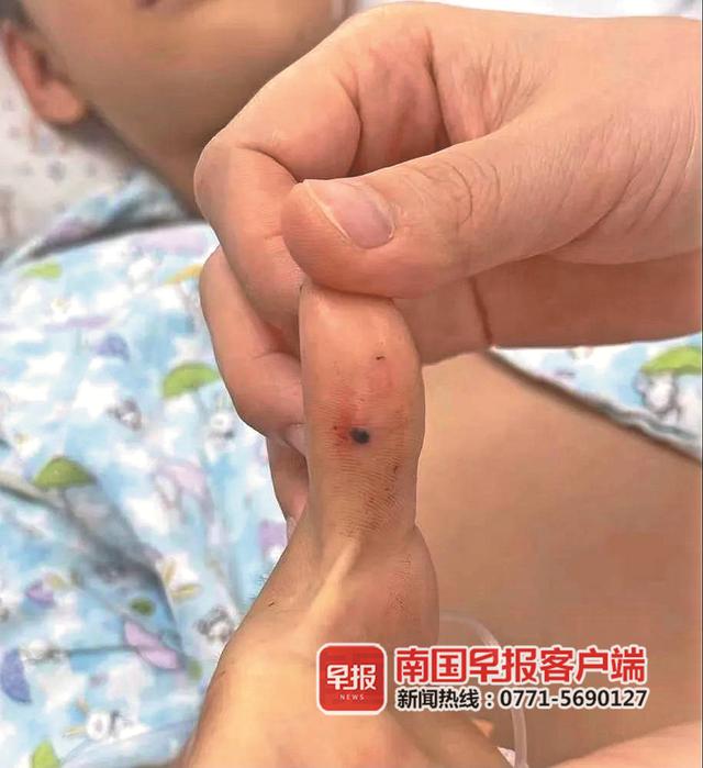 广西一名9岁男童被毒蛇咬伤!担心被责骂未说实情,差点耽误治疗