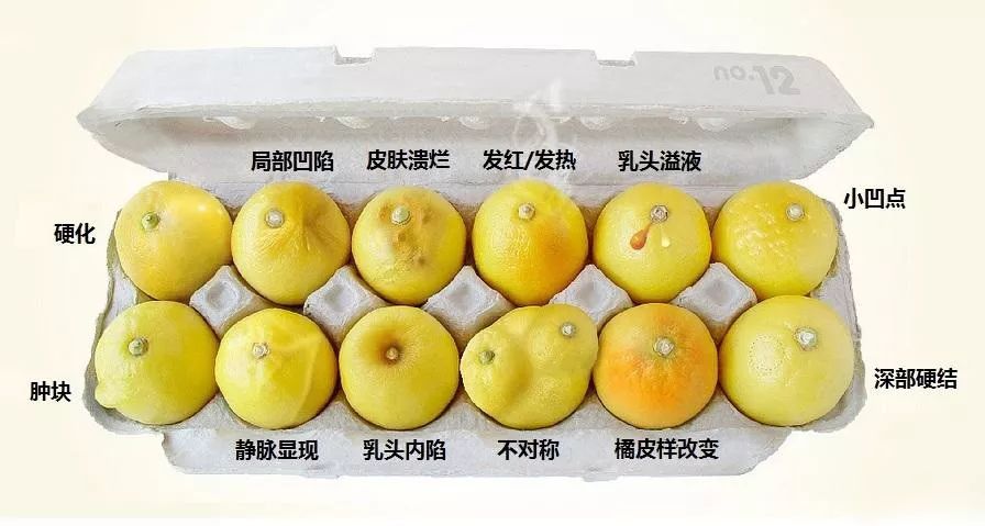 乳腺湿疹样癌图片