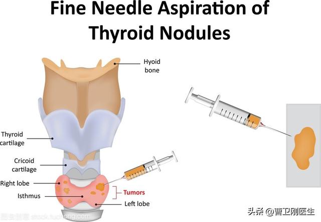 甲状腺穿刺怎么做图片