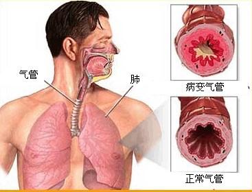 支气管炎的位置图片图片