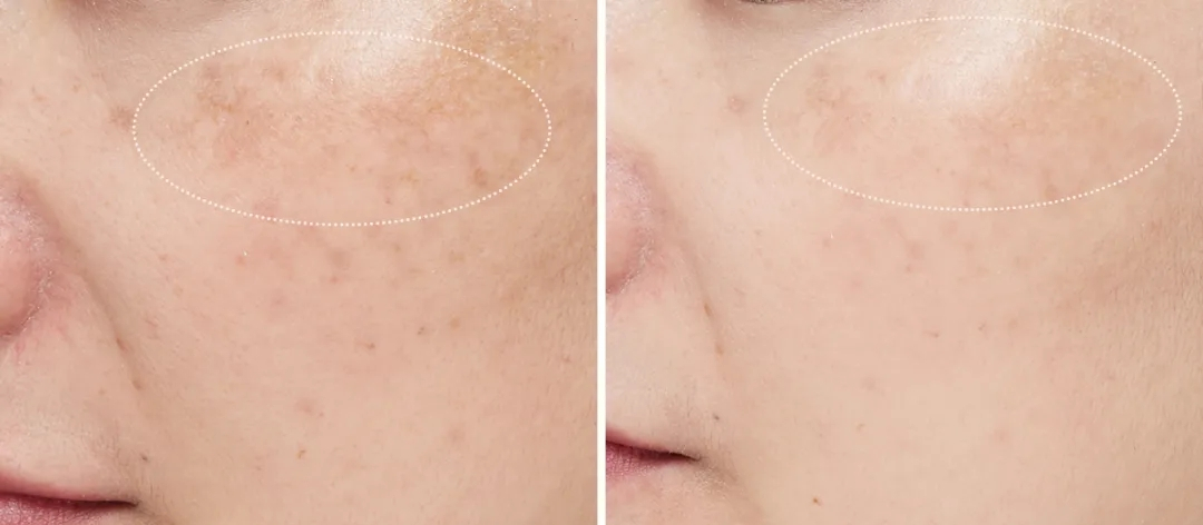 坚持   天下来,表层的黑色素被溶解, 脸蛋短期内提亮美白,但斑点还没