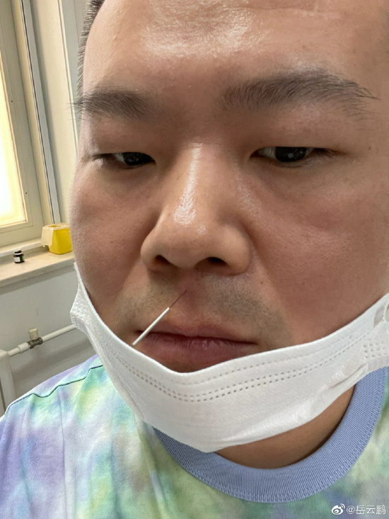 岳云鹏扎针灸晒照 画面搞笑却被医生嘱咐不许笑