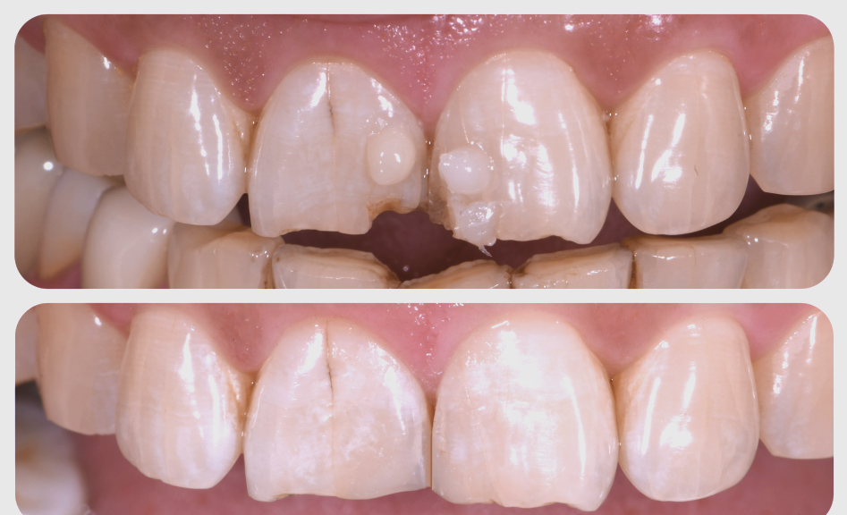 邢台站·美塑树脂修复课程│刘士超成长特训师分享