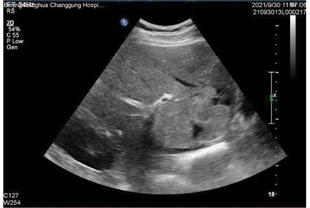 罕见病例多学科联合诊疗原发性肝脏神经内分泌瘤1例