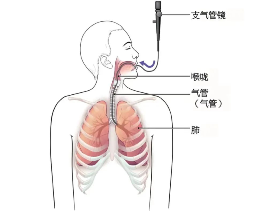 气管镜进镜技巧图解图片