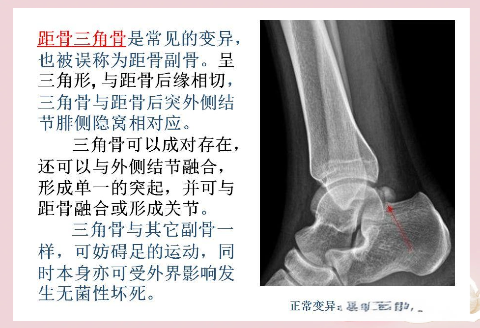 人体中的籽骨,副骨,永存性骨骺与撕脱性骨折的区别及各自特点解析