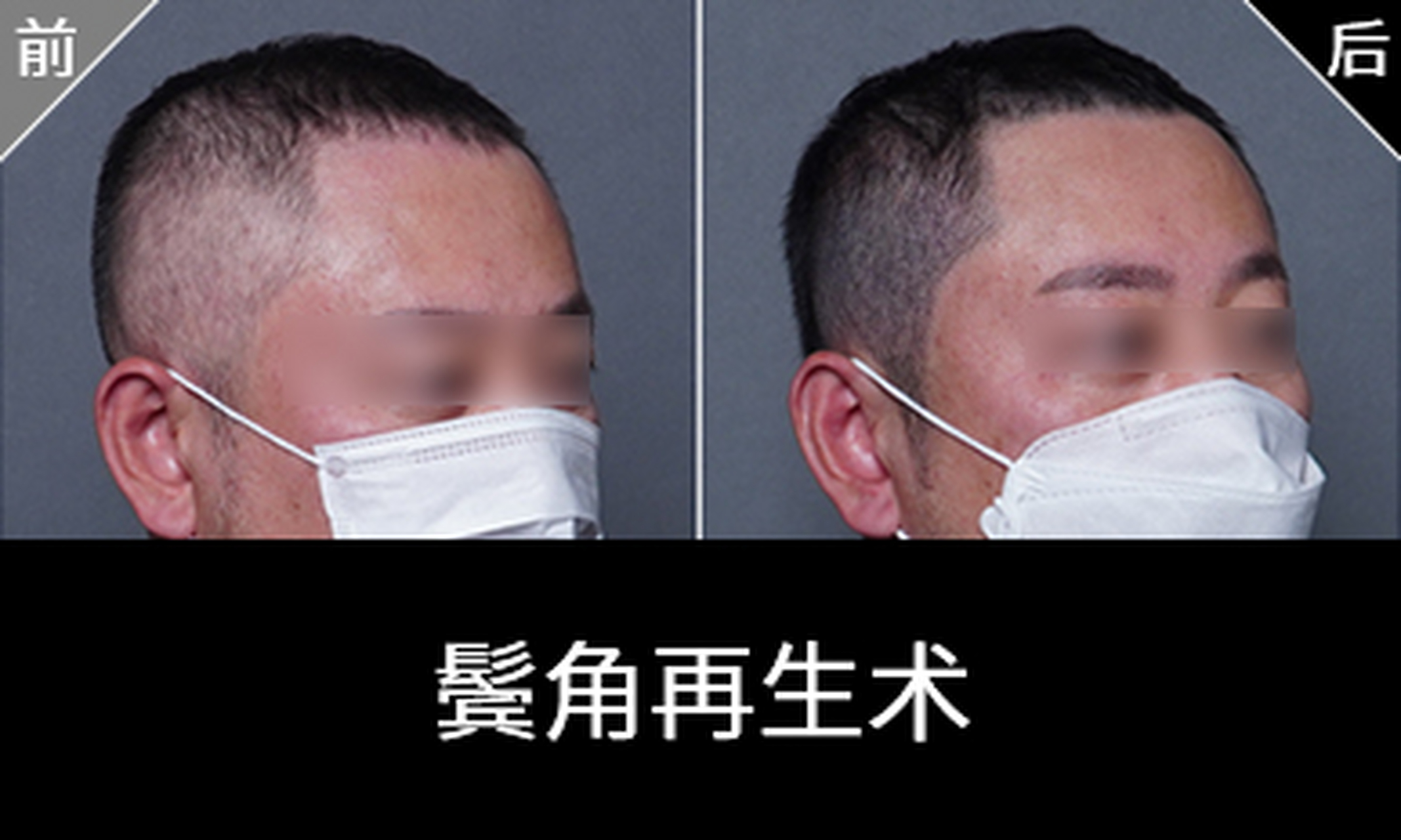 男生纹发际线   男生纹发际线是指通过smp技术,使用头皮微色素着色