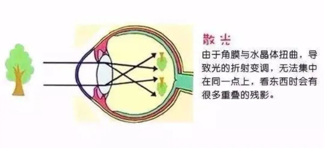 关于散光的危害,新视力自然疗愈为你解答!