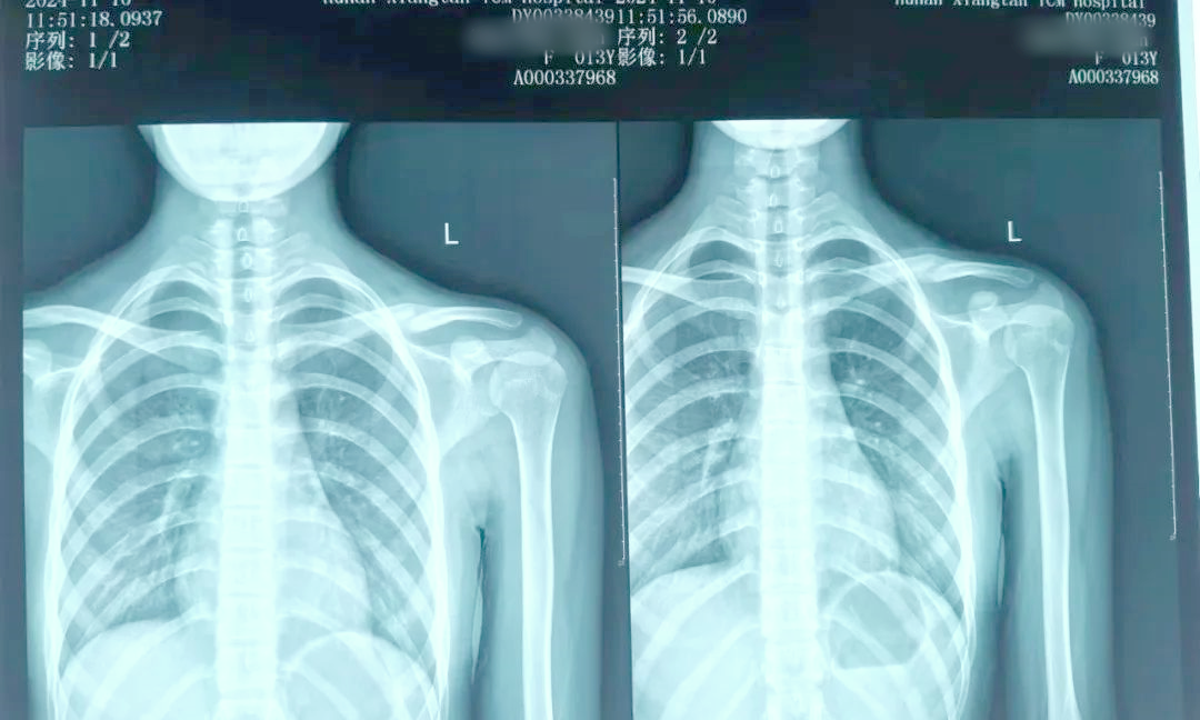 中医正骨助力锁骨骨折治疗,避免手术痛苦