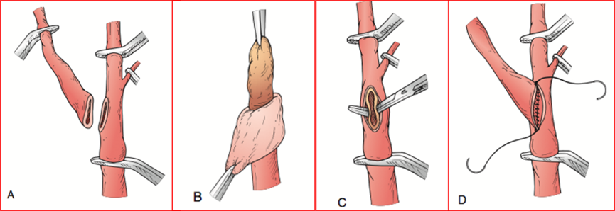 据悉,外翻式颈动脉内膜剥脱术式是针对颈动脉钙化狭