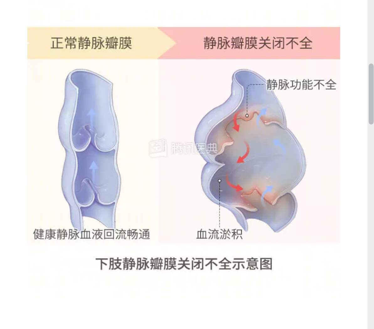 静脉瓣作用图片