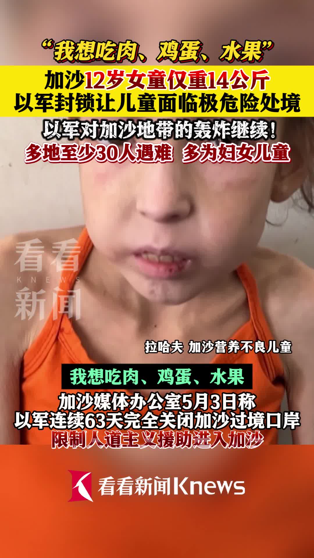 加沙儿童严重营养不良:我想吃肉 鸡蛋 水果