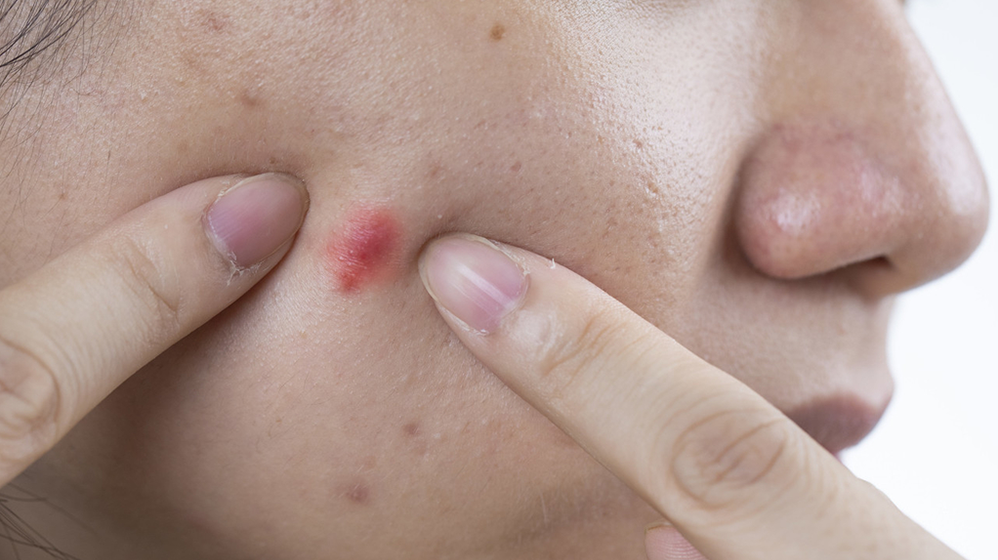 科普|如何战胜"青春痘"?