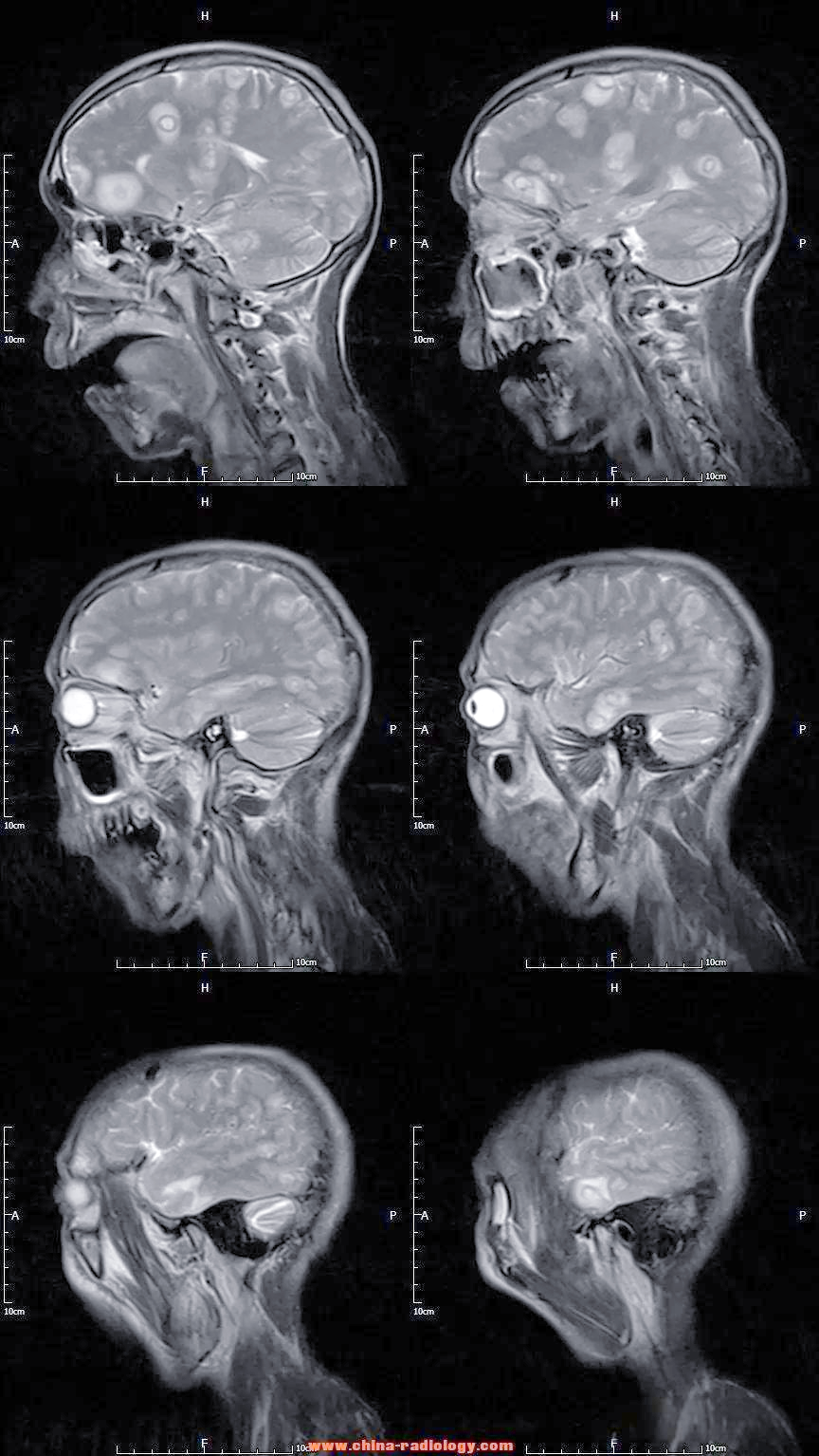 囊虫病:一种常见的中枢神经系统寄生虫感染