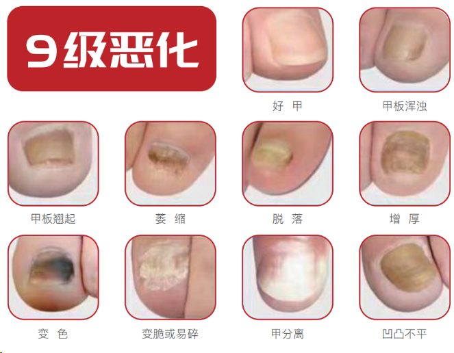 「广州灰指甲哪个医院好」秋冬为什么适合修复灰指甲?