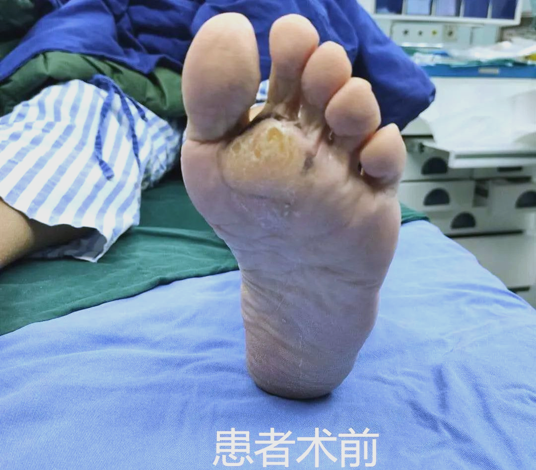 从老茧到关节:足胼胝体的防治指南