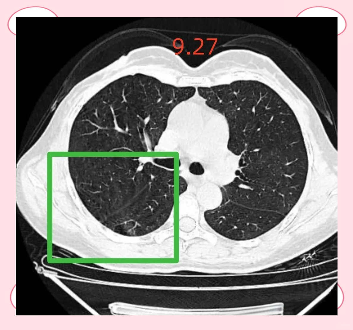 肺结节影像诊断争议:炎症与恶性之间