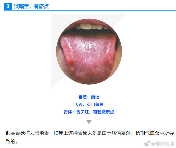 舌头下的青筋脉络粗黑说明了什么健康问题?