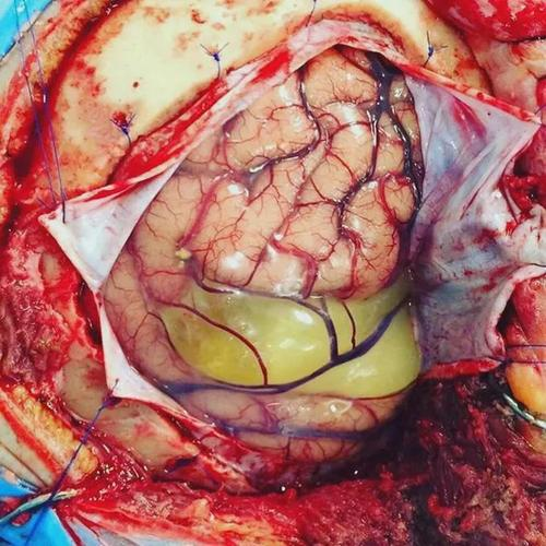 鞍区囊肿的特征,诊断与手术选择详解