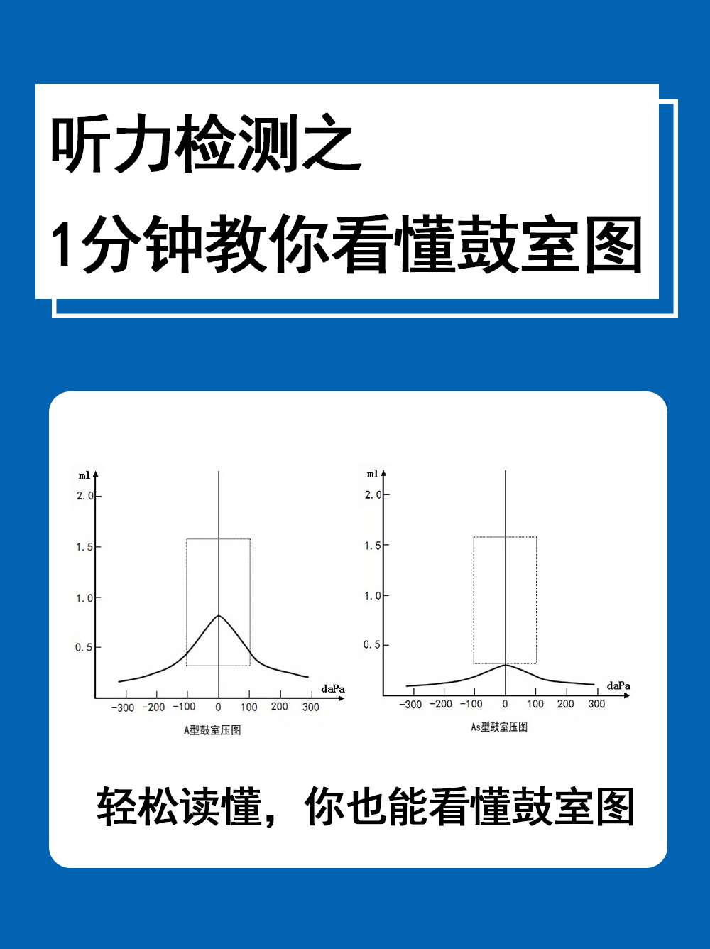 鼓室图分型及其意义图片