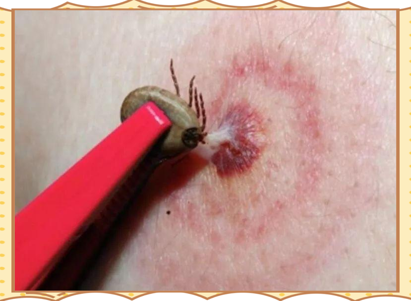 蜱虫钻入肉中如何安全取出?医生为你揭秘!