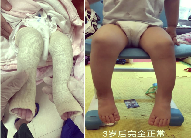 婴儿马蹄内翻足的治疗与注意事项指南