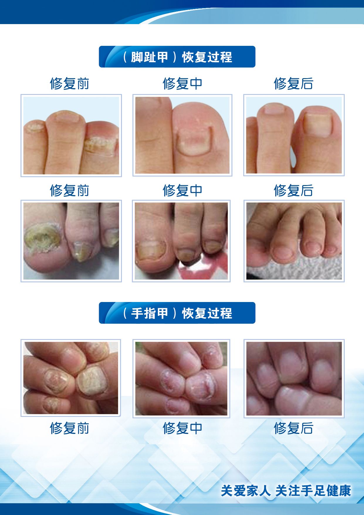 灰指甲的危害性有哪些图片