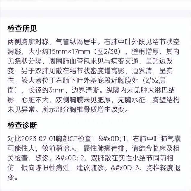 鼻咽癌誘發肺癌需葉切才能確診?別擔心,精準診斷加手術可保平安