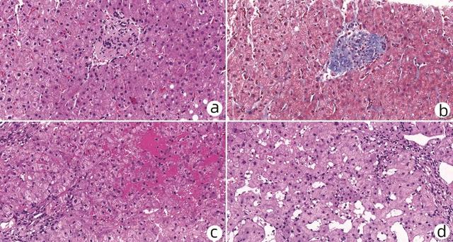 专家论坛｜赵新颜：“基本正常肝组织”的病理鉴别诊断思路