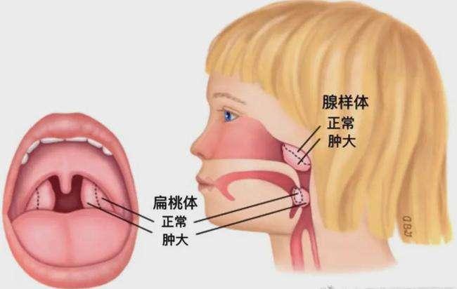 扁桃體腺樣體肥大危害多,兄弟倆通過手術共同治癒