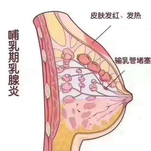 哺乳期乳房有肿块,是乳腺增生还是乳汁淤积?如何判断与治疗?